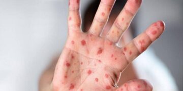 साउदी अरबबाट फर्किएका एक नेपालीमा मंकीपक्स पुष्टि, कत्तिको छ खतरनाक ?